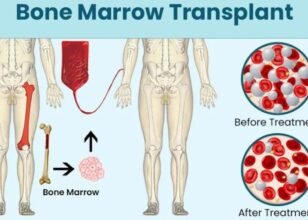 Bone Marrow Transplant