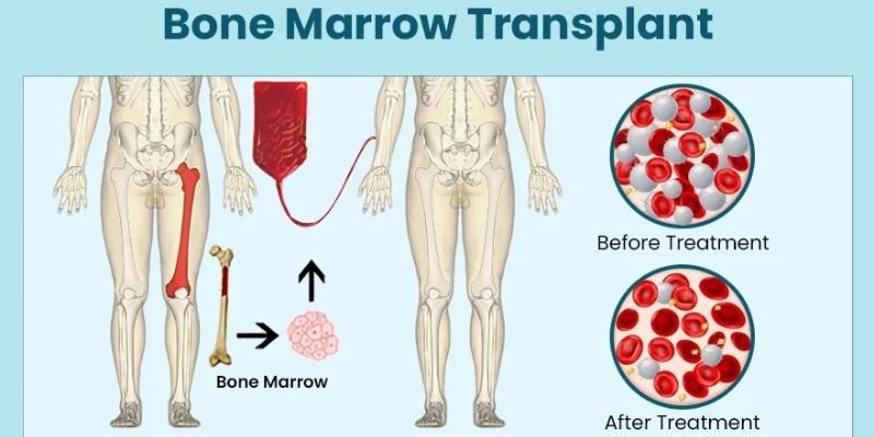 Bone Marrow Transplant