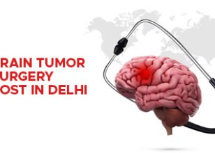 Brain Tumour Treatment in Delhi