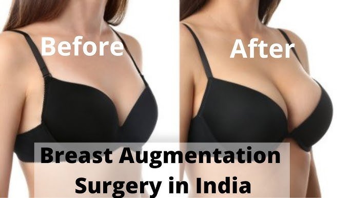 Breast Augmentation in india