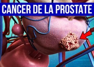 Cancer de la prostate