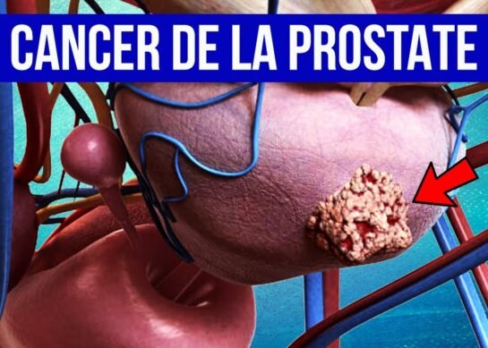 Cancer de la prostate