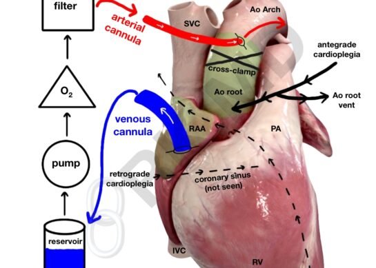 Cardiopulmonary Bypass Surgery: A Life-Saving Procedure for Heart Patients