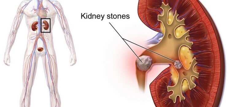 Kidney Stones Diagnosis & Treatment in Delhi