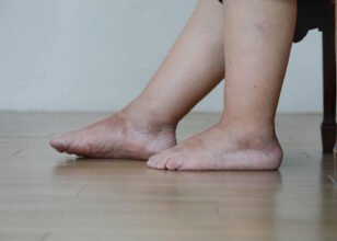 Leg Swelling and Discolouration? Recognising Vascular Disorders in Time