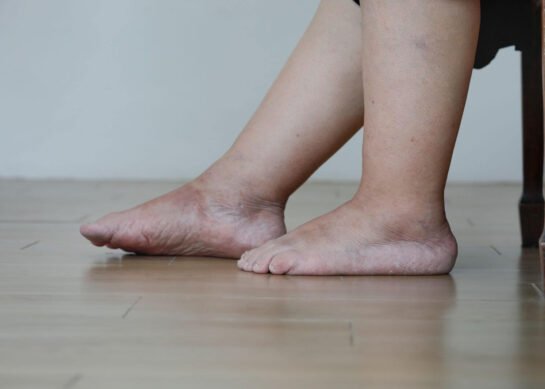 Leg Swelling and Discolouration? Recognising Vascular Disorders in Time