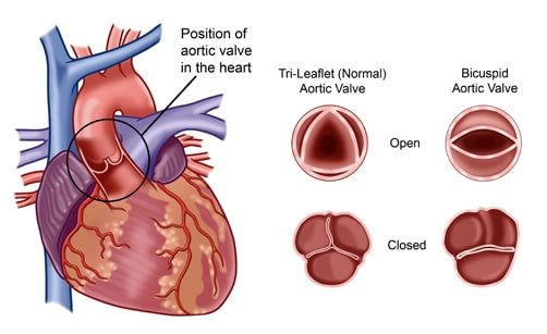 Mitral Valve Replacement Surgery in Delhi