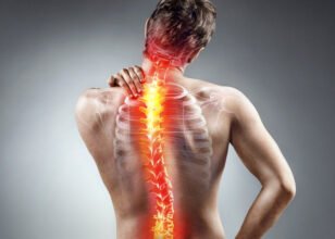 Successful Scoliosis Treatment in India: A Global Destination for Care