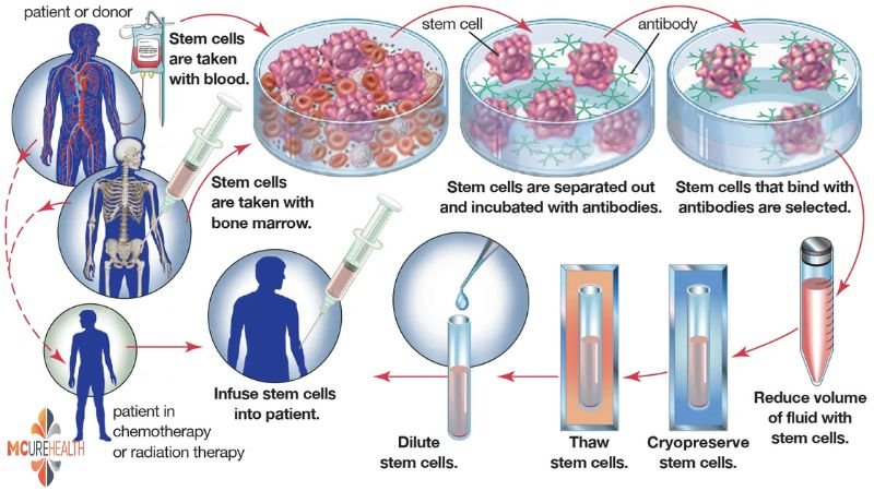 Greffe de moelle osseuse en Inde avec Mcure Health | Des soins de pointe à un prix abordable